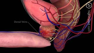 Open Prostatectomy [upl. by Eenehs]