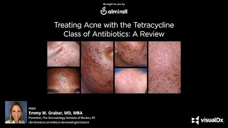 Treating Acne with the Tetracycline Class of Antibiotics A Review [upl. by Giraud]