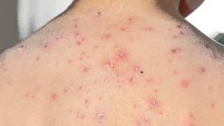 Shingles  Daily Dos of Dermatology [upl. by Ybrad655]