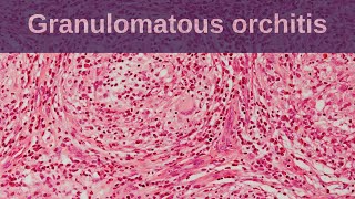 Idiopathic Granulomatous Orchitis  Pathology mini tutorial [upl. by Nodearb]