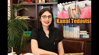 Kanal tedavisi  Nedir  Ne zaman ve nasıl yapılır [upl. by Kennet]