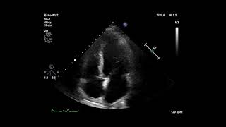 Cardiac Ultrasonogram Showing Apical 4 Chamber View [upl. by Northway]