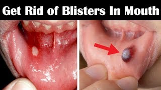 How to Get Rid of Blisters in Mouth Fast  Home Remedies for Blisters in Mouth and Tongue [upl. by Egor]