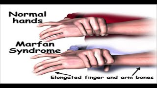 Marfan Syndrome [upl. by Atsiuqal]