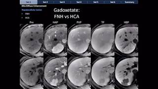 CT Differential Diagnosis of Focal Hepatic Lesions Basic Radiology [upl. by Ioved]