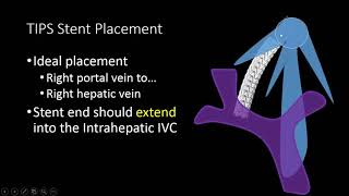 TIPS Stent US Doppler Evaluation [upl. by Neelrak]