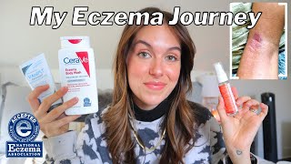 HOW I BEAT MY ECZEMA FOR GOOD  My journey product recommendations  body care tips  Rudi Berry [upl. by Hortense492]