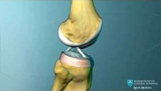 Knee Chondromalcia and Its Treatment [upl. by Kcirdnekal202]