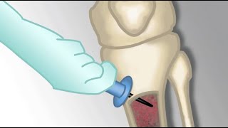 Placement of an Intraosseous Line by MKleinman  OPENPediatrics [upl. by Annaed810]