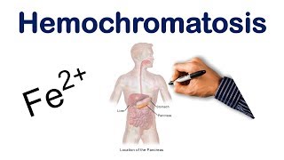 Hemochromatosis  USMLE COMLEX NCLEX [upl. by Kimmel861]