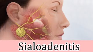 Sialoadenitis inflamación sublingual granos rojos tratamiento [upl. by Negem]