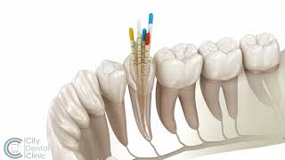 Endodontics  Root canal treatment  City Dental Clinic Bratislava [upl. by Boak475]