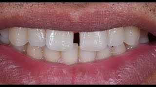 Diastema closure using Bioclear method [upl. by Teddman107]