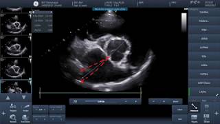 Video 1  How to perform basic echocardiographic measurements  LAAo [upl. by Doughman]