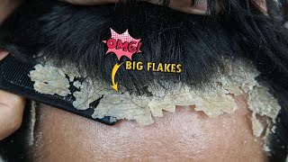 Satisfying Itchy Dry Scalp Scratching Dandruff 1187 [upl. by Zirkle650]