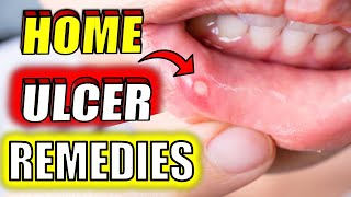 19 Fast amp Effective MOUTH ULCER Home Remedies CANKER SORES [upl. by Norat]