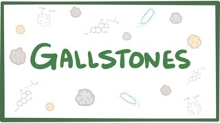 Gallstones cholelithiasis [upl. by Lenz579]