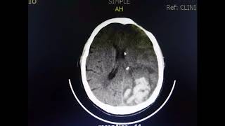 Tac cráneo  Hemorragia intraparenquimatosa [upl. by Vigen]