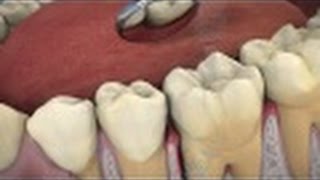 The Role of ARESTIN® in Periodontal Treatment [upl. by Atterg976]