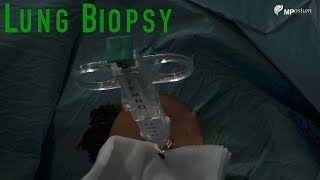 Kidney biopsy procedure [upl. by Cornelle407]