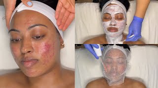 CYSTIC ACNE TREATMENT  WALKIN FACIAL FOR GRADE 3 AND 4 ACNE WITH PRO TIPS  LICENSED ESTHETICIAN [upl. by Barkley]