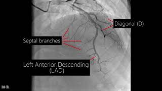 Atherosclerosis Unblock Blood Vessels Inner Walls Plaques Breakdown [upl. by Aniv]