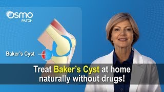 Bakers Cyst Treatment  What you need to know [upl. by Jobey]