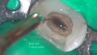 Endodontist Retreatment of a Max 2nd Premolar [upl. by Pauletta556]