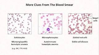 Anemia Lesson 4  Clues from the blood smear [upl. by Emelen]