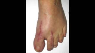 Minimally Invasive Foot Surgery  Hallux Varus Correction [upl. by Tallia]