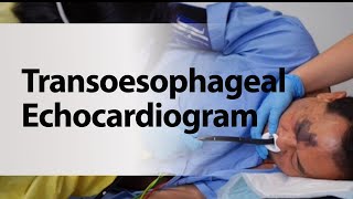 Transoesophageal Echocardiogram [upl. by Gretel]