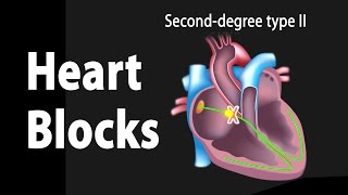 Heart Blocks Anatomy and ECG Reading Animation [upl. by Lombard]