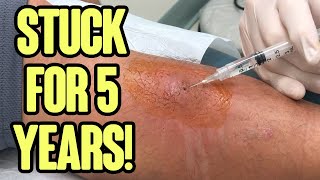 Leg Double Feature  Infected Leg and Amazing Toothpick Splinter Removal [upl. by Jenelle]