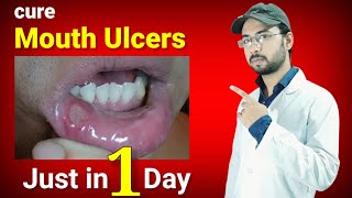 cure mouth ulcers just in one day permanently  mouth ulcer home remedy  canker sore home remedy [upl. by Fredella91]