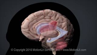 Intracerebral Hemorrhage Stroke [upl. by Htenaj6]