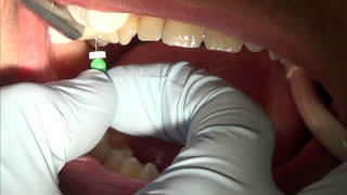 root canal treatment part 1 [upl. by Hnim]