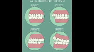 Different Types of Malocclusions [upl. by Tower942]