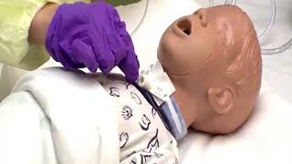 Surgical tracheostomy procedure [upl. by Enilrac]