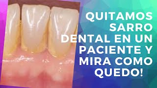 LE QUITAMOS EL SARRO A UN PACIENTE MIRA COMO QUEDO Limpieza dental con ultrasonido y profilaxis [upl. by Chilson]