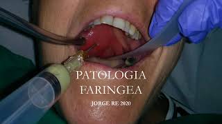 PATOLOGIA FARINGEA Faringoamigdalitis Absceso profundo de cuello APNEA DEL SUEÑO [upl. by Greyso225]