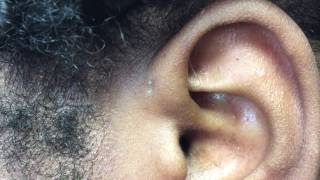 Congenital Preauricular Fistula [upl. by Ojillib]