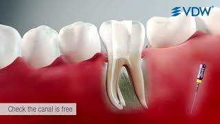 VDW Dental · How To Root canal preparation with RECIPROC blue R25 [upl. by Yecam]