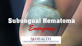 Subungual Hematoma Emergency and Trephination Procedure [upl. by Eenafets]