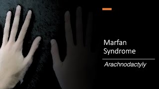 Marfan Syndrome  Diagnosis by Prof Julie De Backer [upl. by Dion]