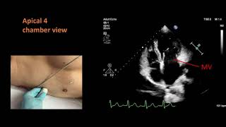 Standard views for a basic echocardiogram [upl. by Nevur219]