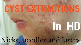 Cysts extractions blackheads  Removal methods in HD [upl. by Ardnasella658]