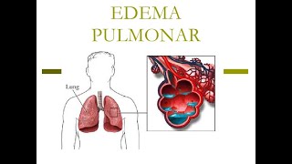 Edema Agudo de Pulmón MEDICINA INTERNA [upl. by Eire674]