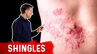 Shingles Natural Relief [upl. by Leugar323]