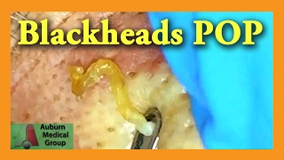 Blackheads POP  Auburn Medical Group [upl. by Ertsevlis]