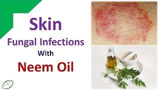 Get rid skin Fungal Infections with Neem Oil [upl. by Dredi607]